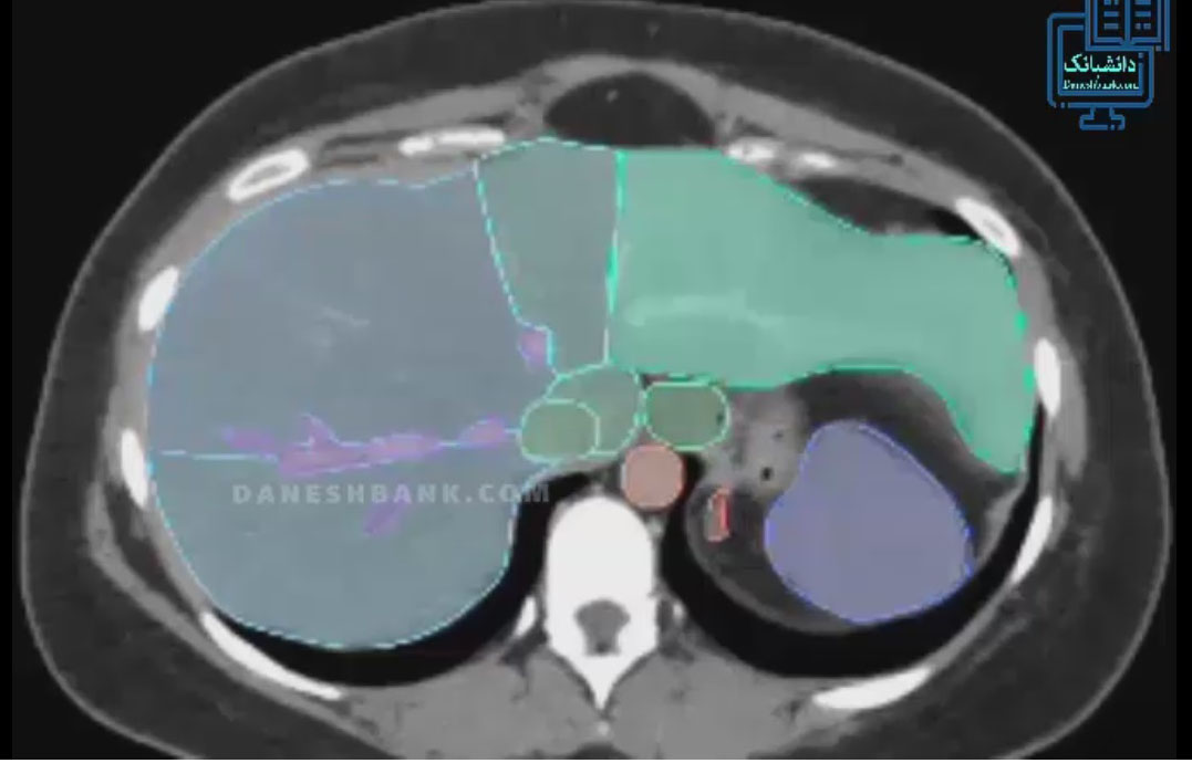  آموزش تفسیر سیتی اسکن  با جزئیات چند اندام مهم شکم و لگن